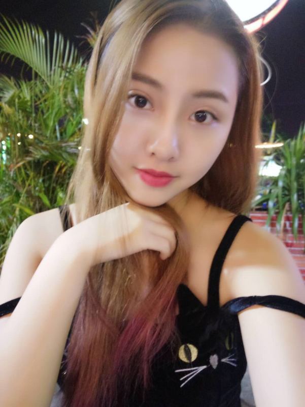 整形醫(yī)生徐長亮做切開雙眼皮案例效果對比圖