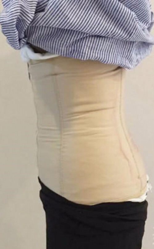 合肥壹加壹整形醫(yī)生周福田做腰腹吸脂案例