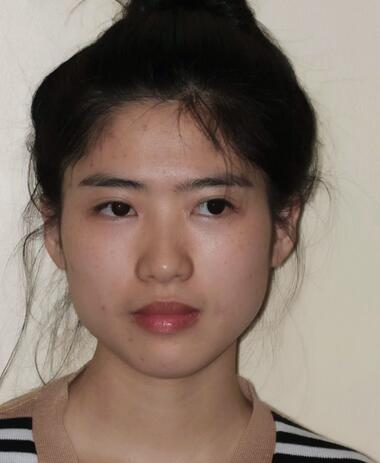 北京彤美整形醫(yī)院趙彤醫(yī)生做下頜角整形怎么樣？下頜角整形案例展示