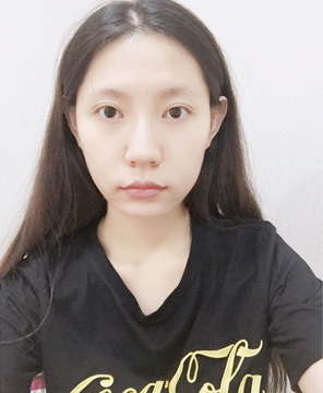  濟(jì)南安美醫(yī)療整形醫(yī)生李思思下頜角整形案例