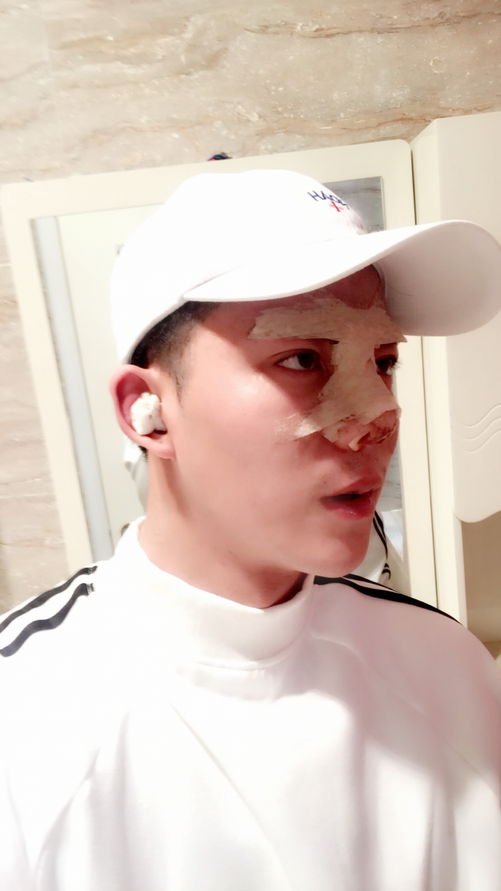 濟寧名美醫(yī)療整形醫(yī)生李唯少假體隆鼻+耳軟骨墊鼻尖真實案例效果對比圖