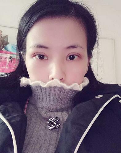 楊勇山雙眼皮案例展示