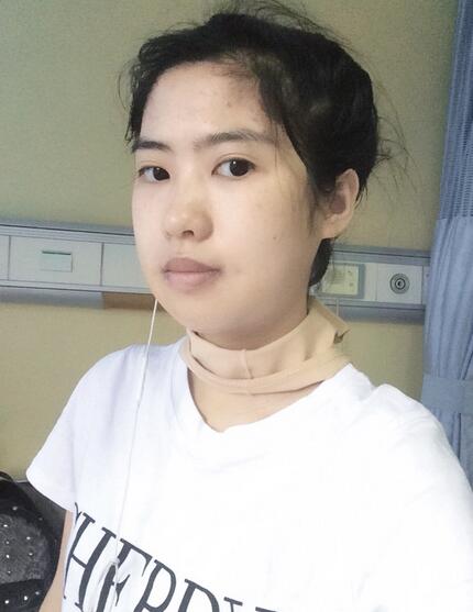 下頜角手術(shù)第八天