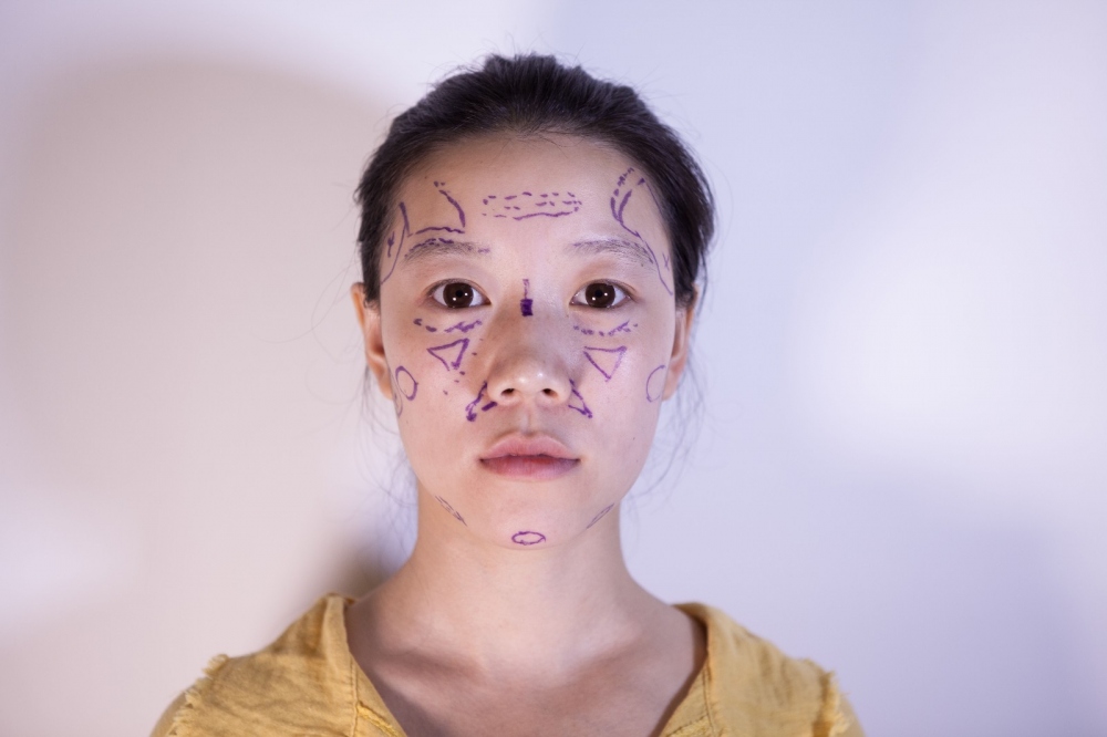 山西伊特雅整形醫(yī)生王鳳芹自體脂肪豐面頰+V-LINE瓜子臉手術(shù)案例效果圖 山西伊特雅整形醫(yī)生王鳳芹自體脂肪豐面頰+V-LINE瓜子臉手術(shù)案例效果圖