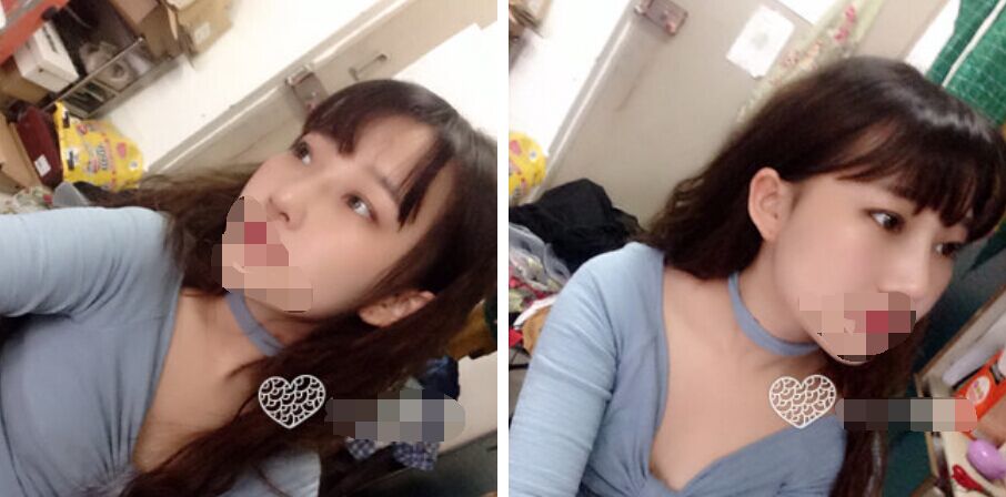 珠海艾瑞醫(yī)療美容醫(yī)院余昌盛醫(yī)生做耳軟骨隆鼻真實(shí)案例分享