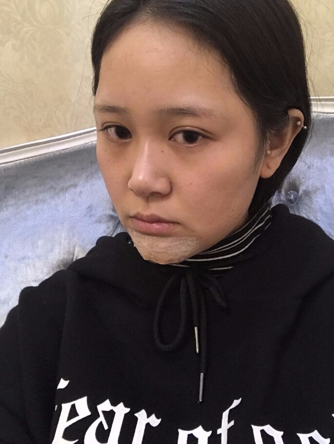 青島集美整形醫(yī)院做硅膠墊下巴怎么樣？趙煜楠醫(yī)生硅膠墊下巴真人案例