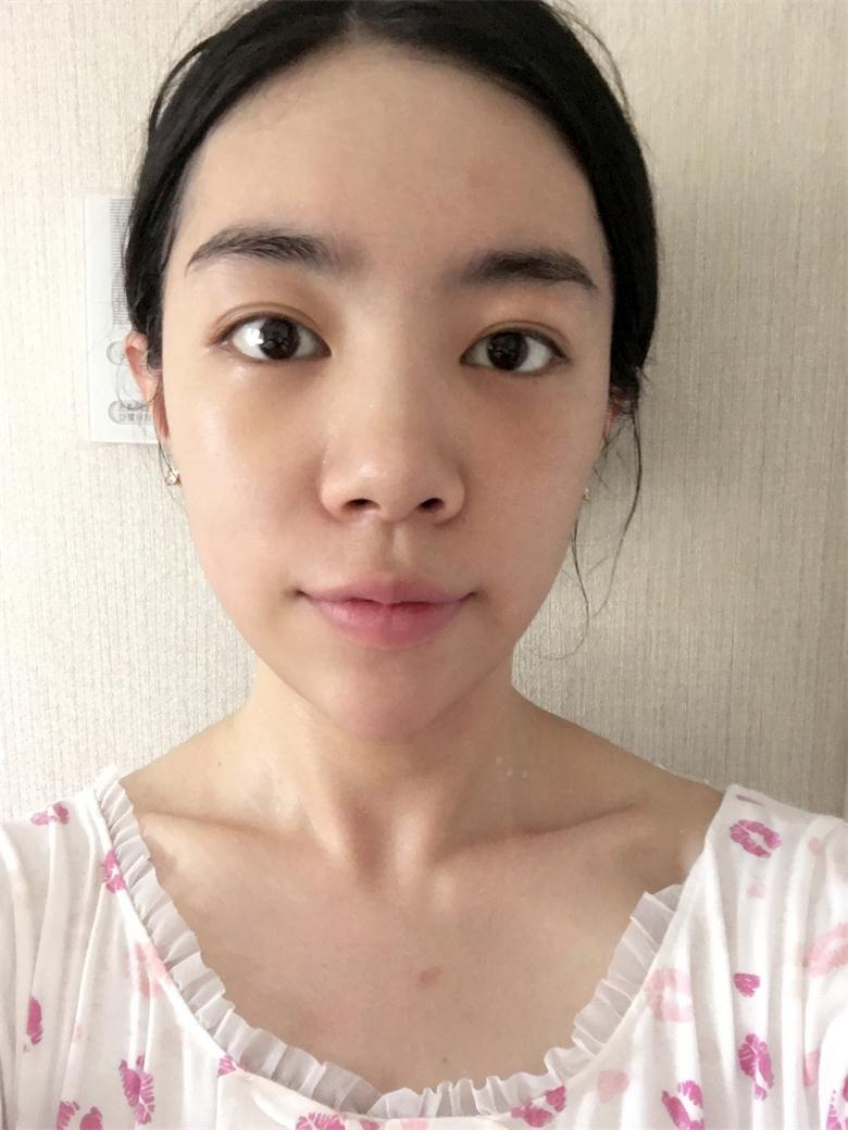 合肥壹加壹整形美容醫(yī)院做祛眼袋效果怎么樣？金大生祛眼袋案例分享