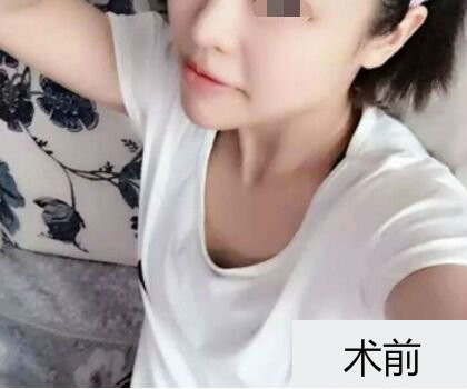 深圳博美整形醫(yī)生劉超做自體脂肪隆胸怎么樣？自體脂肪隆胸案例