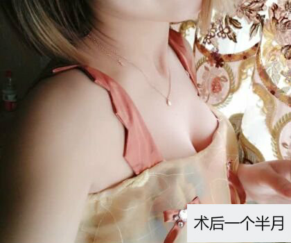 深圳博美整形醫(yī)生劉超做自體脂肪隆胸怎么樣？自體脂肪隆胸案例