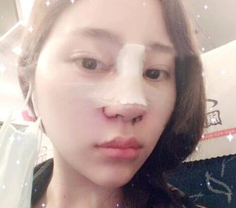 蘇州明基醫(yī)院醫(yī)療美容科做鼻綜合整形怎么樣？蘇州明基鼻綜合整形案例