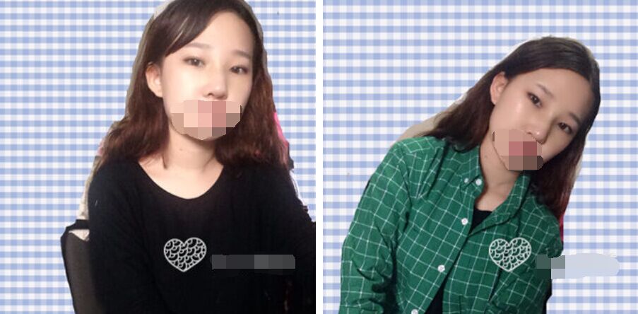 珠海艾瑞醫(yī)療美容醫(yī)院余昌盛醫(yī)生做耳軟骨隆鼻真實(shí)案例分享