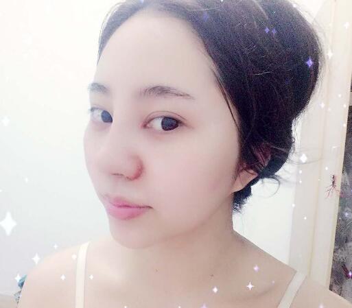 蘇州明基醫(yī)院醫(yī)療美容科做鼻綜合整形怎么樣？蘇州明基鼻綜合整形案例