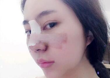 蘇州明基醫(yī)院醫(yī)療美容科做鼻綜合整形怎么樣？蘇州明基鼻綜合整形案例