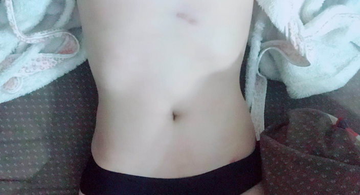 深圳晨曦整形醫(yī)院吉米斯做腰腹吸脂怎么樣？附吉米斯醫(yī)生腰腹吸脂案例