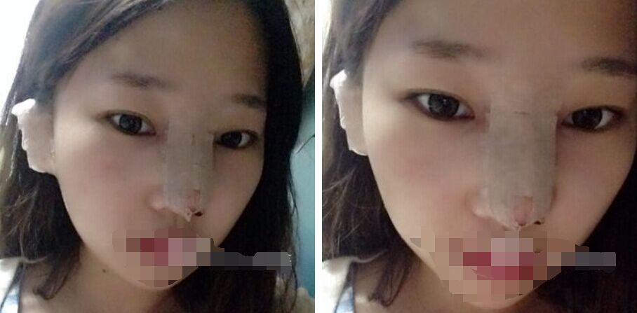 珠海艾瑞醫(yī)療美容醫(yī)院余昌盛醫(yī)生做耳軟骨隆鼻真實(shí)案例分享