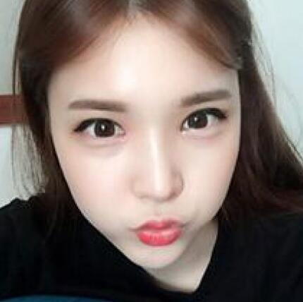 象山華美整形美容醫(yī)院趙誠厚醫(yī)生做切開雙眼皮+開內眼角整形案例