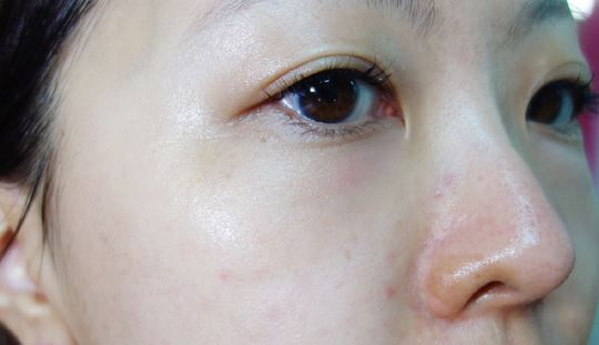 徐州時光洪揚(yáng)醫(yī)療美容診所宮昔愿醫(yī)生做激光祛斑效果怎么樣？