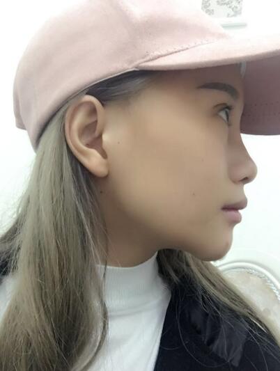 長春奧拉克美容醫(yī)院金相勛醫(yī)生做玻尿酸豐臥蠶怎么樣？附案例