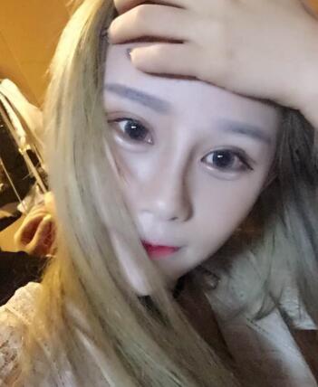 長春奧拉克美容醫(yī)院金相勛醫(yī)生做玻尿酸豐臥蠶怎么樣？附案例