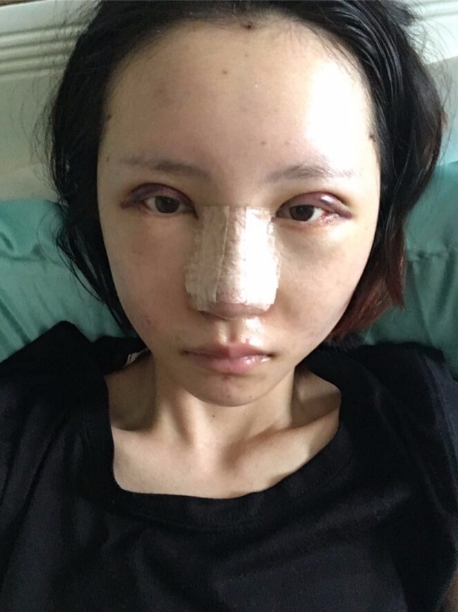 長沙愛思特整形醫(yī)院陳星光醫(yī)生做鼻部多項+自體脂肪隆鼻+切開雙眼皮+開外眼角案例