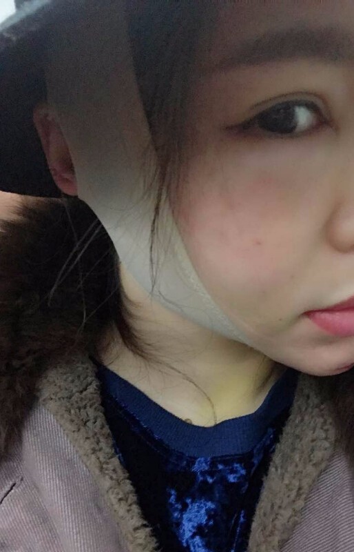 重慶聯(lián)合麗格美容醫(yī)院林麗蓉醫(yī)生做自體脂肪豐蘋果肌怎么樣？附案例