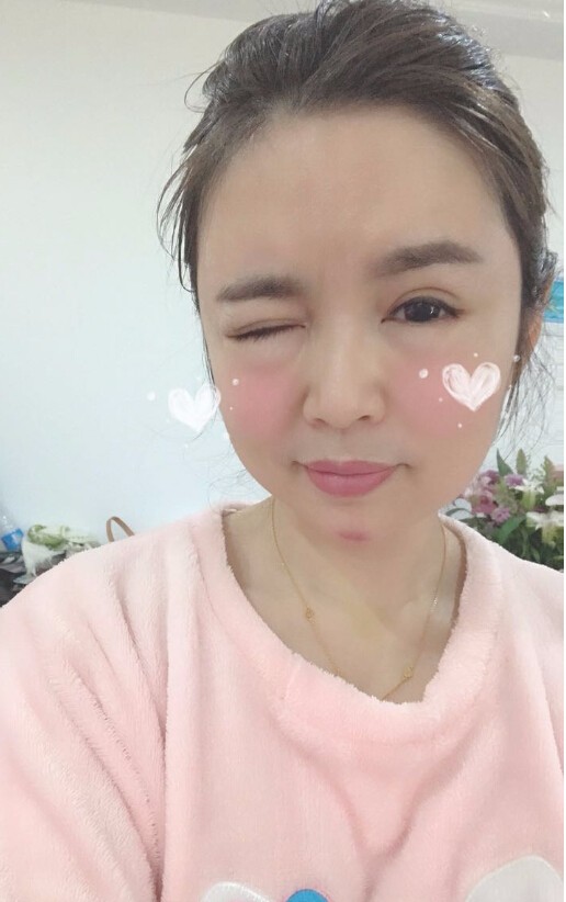 重慶聯(lián)合麗格美容醫(yī)院林麗蓉醫(yī)生做自體脂肪豐蘋果肌怎么樣？附案例