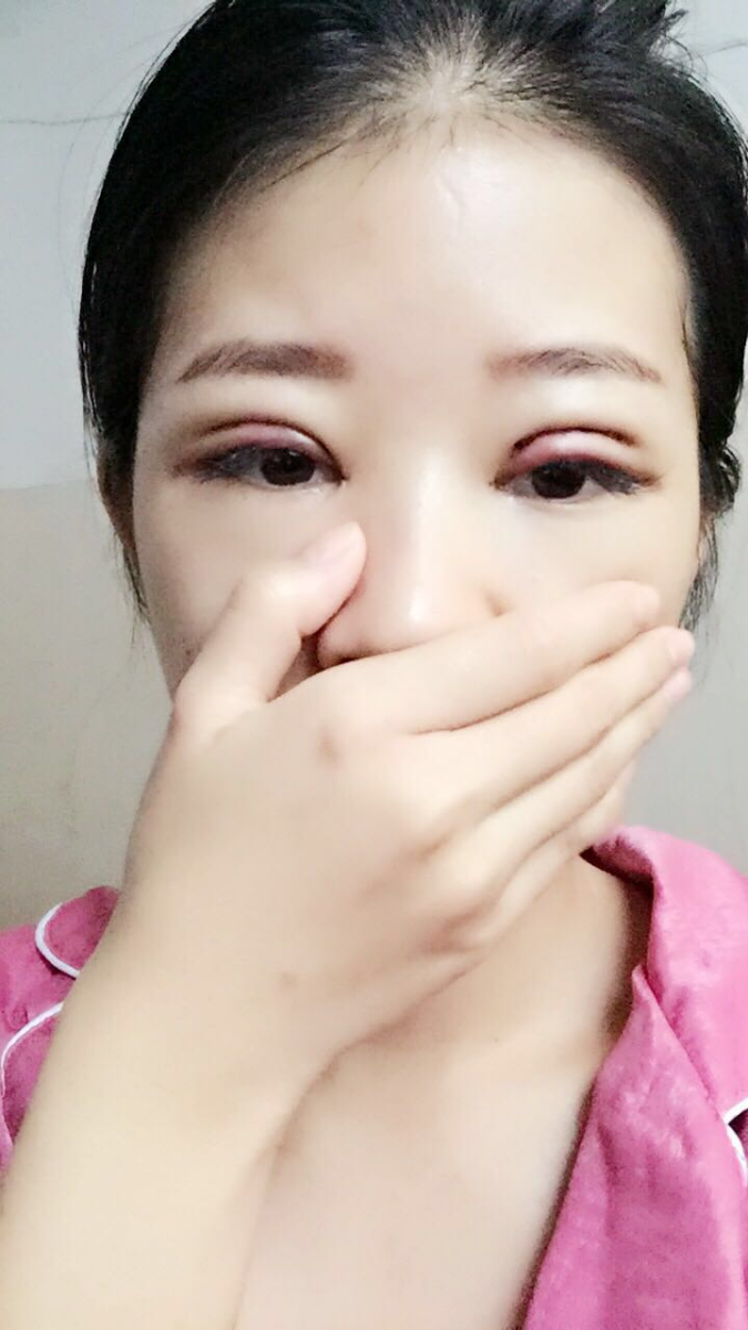 深圳晨曦醫(yī)療整形醫(yī)生吉米斯做切開雙眼皮怎么樣？吉米斯切開雙眼皮案例效果