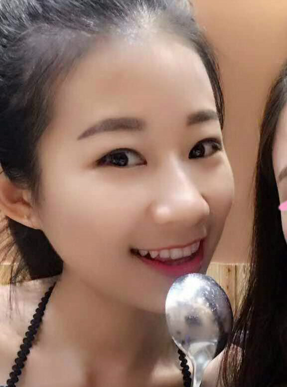 深圳晨曦醫(yī)療整形醫(yī)生吉米斯做切開雙眼皮怎么樣？吉米斯切開雙眼皮案例效果