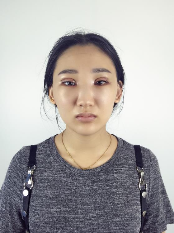 武漢中翰整形外科醫(yī)院沈磊醫(yī)生做切開(kāi)雙眼皮怎么樣？附沈磊切開(kāi)雙眼皮案例