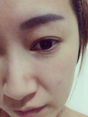 重慶五洲女子醫(yī)院整形美容中心做光子嫩膚怎么樣？淡明斌醫(yī)生光子嫩膚案例