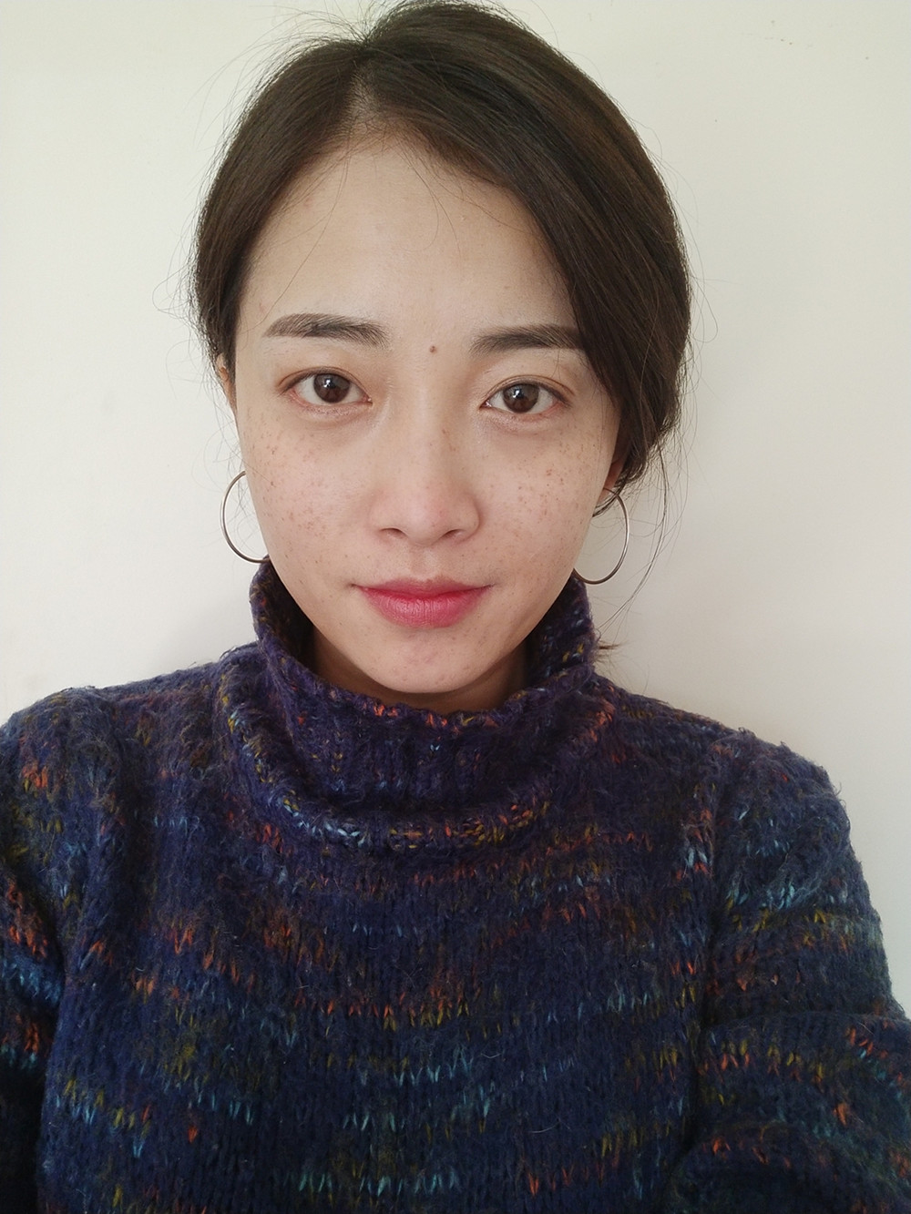 重慶當(dāng)代整形李敏旭醫(yī)生做皮秒激光祛斑效果怎么樣？附皮秒激光祛斑案例