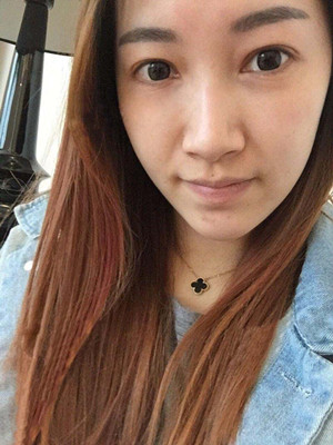 重慶五洲女子醫(yī)院整形美容中心做光子嫩膚怎么樣？淡明斌醫(yī)生光子嫩膚案例