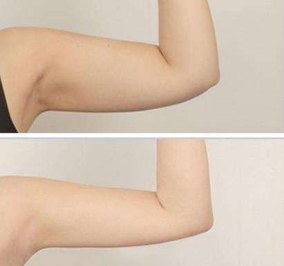 廣州醫(yī)學(xué)院第二附屬醫(yī)院整形美容中心手臂吸脂