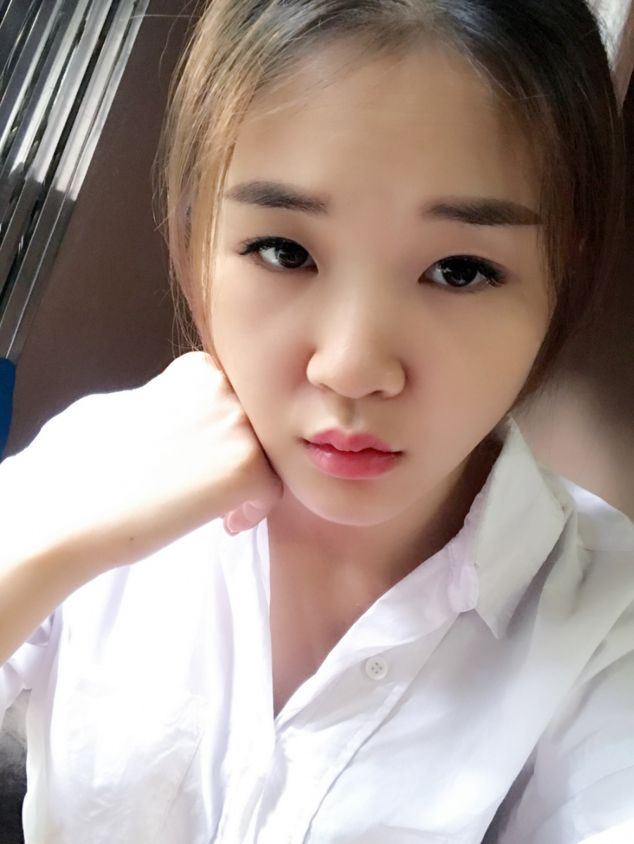 鄭州華領(lǐng)醫(yī)療美容醫(yī)院賀小虎醫(yī)生做眼綜合+鼻部整形手術(shù)效果怎么樣？