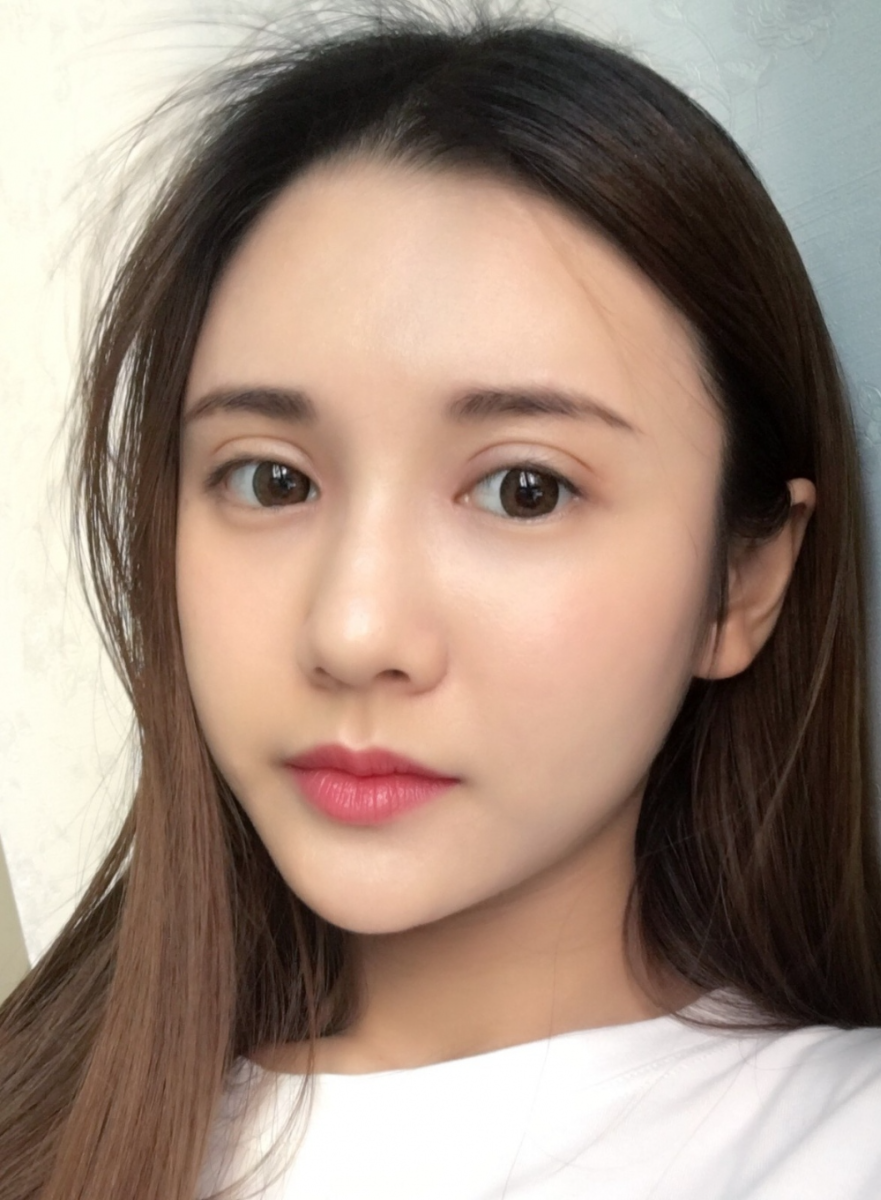 鄭州銘藝整形醫(yī)生陳濤做切開雙眼皮怎么樣？鄭州銘藝切開雙眼皮案例