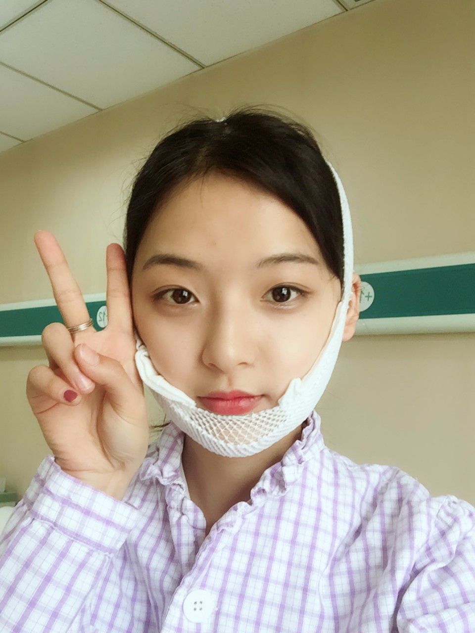 鄭州名門整形醫(yī)院董斌醫(yī)生做下頜角整形怎么樣？附下頜角整形案例