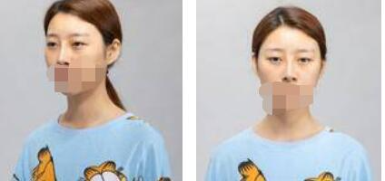 太原歐美蓮整形醫(yī)院丁曉峰醫(yī)生做雙眼皮怎么樣？丁曉峰雙眼皮手術(shù)案例分享