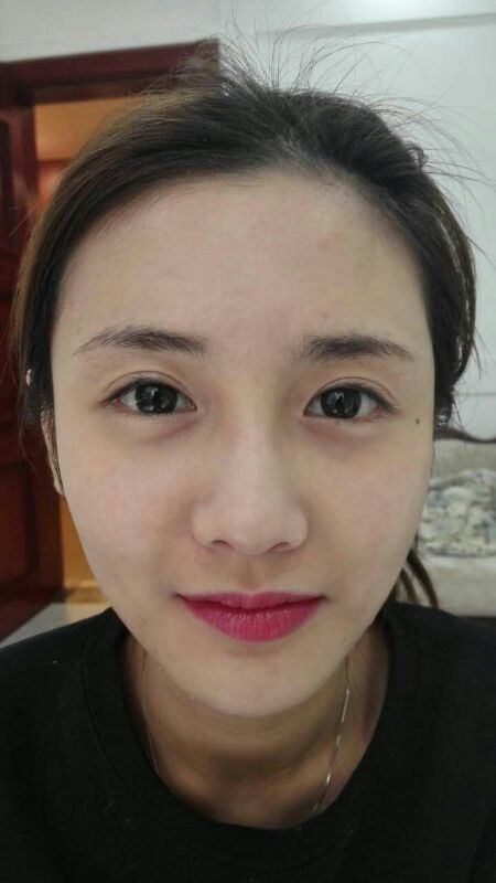 鄭州銘藝整形醫(yī)生陳濤做切開雙眼皮怎么樣？鄭州銘藝切開雙眼皮案例