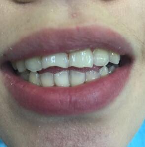 武漢康承貝健口腔醫(yī)院宋磊醫(yī)生做二氧化鋯全瓷牙效果怎么樣？附案例