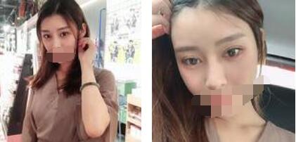 太原歐美蓮整形醫(yī)院丁曉峰醫(yī)生做雙眼皮怎么樣？丁曉峰雙眼皮手術(shù)案例分享