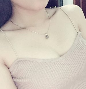 珠海萊茵醫(yī)療美容醫(yī)院崔俊溶醫(yī)生做自體脂肪隆胸效果怎么樣？附自體脂肪隆胸案例