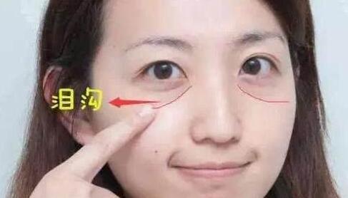 貴陽顏之美整形自體脂肪填充淚溝