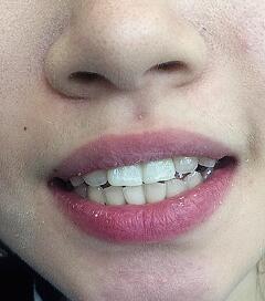 武漢康承貝健口腔醫(yī)院宋磊醫(yī)生做二氧化鋯全瓷牙效果怎么樣？附案例