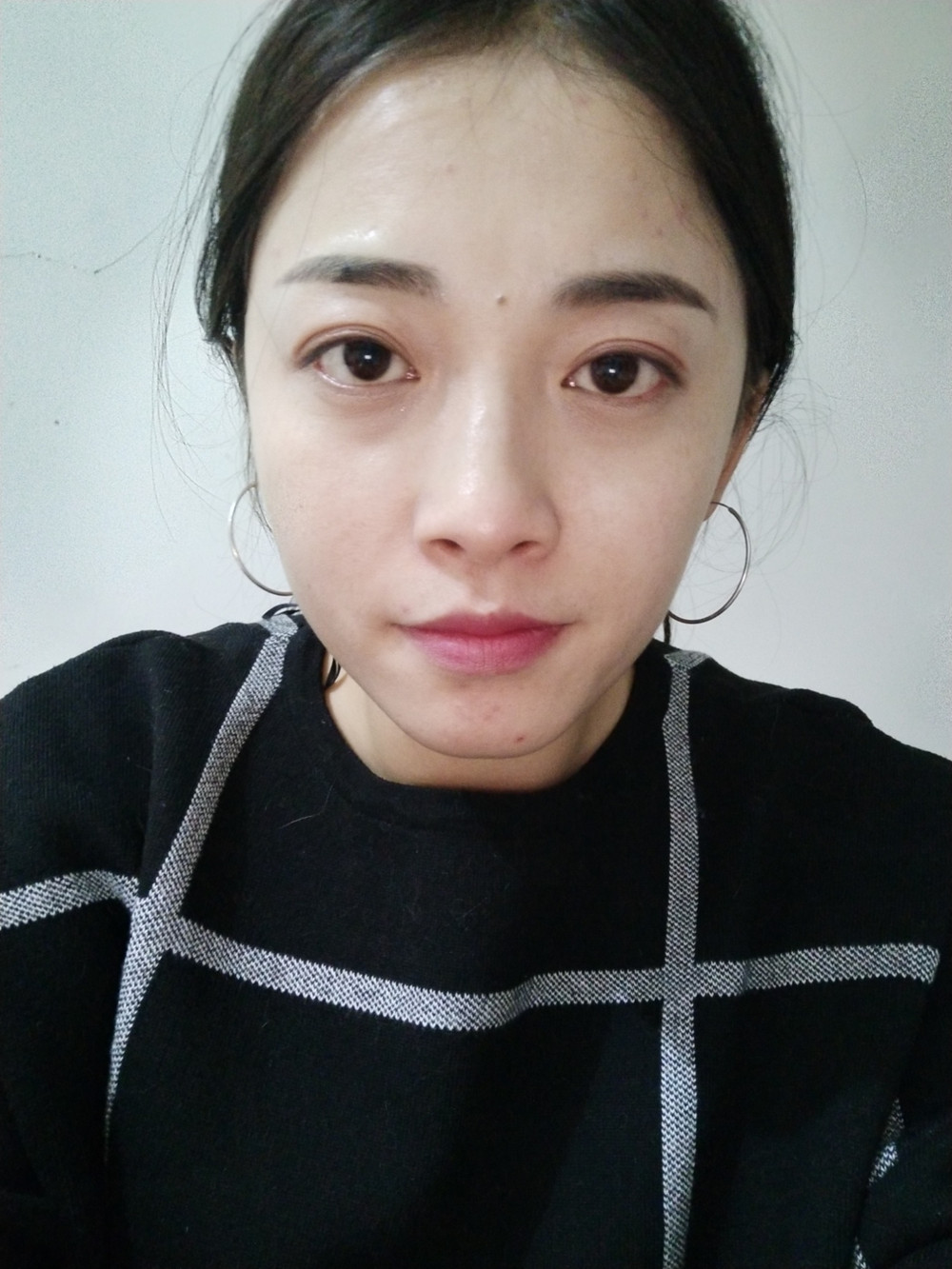 重慶當(dāng)代整形李敏旭醫(yī)生做皮秒激光祛斑效果怎么樣？附皮秒激光祛斑案例