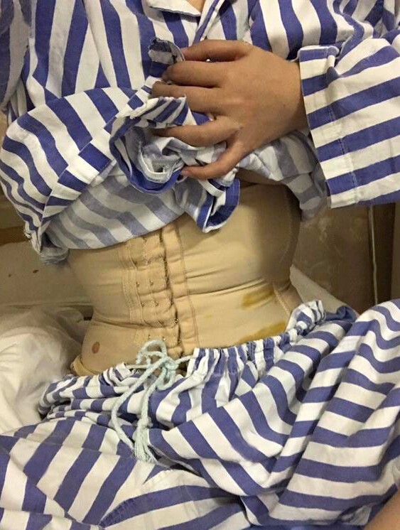 長沙亞韓醫(yī)學(xué)整形醫(yī)生米勒做腰腹吸脂效果怎么樣？米勒腰腹吸脂案例