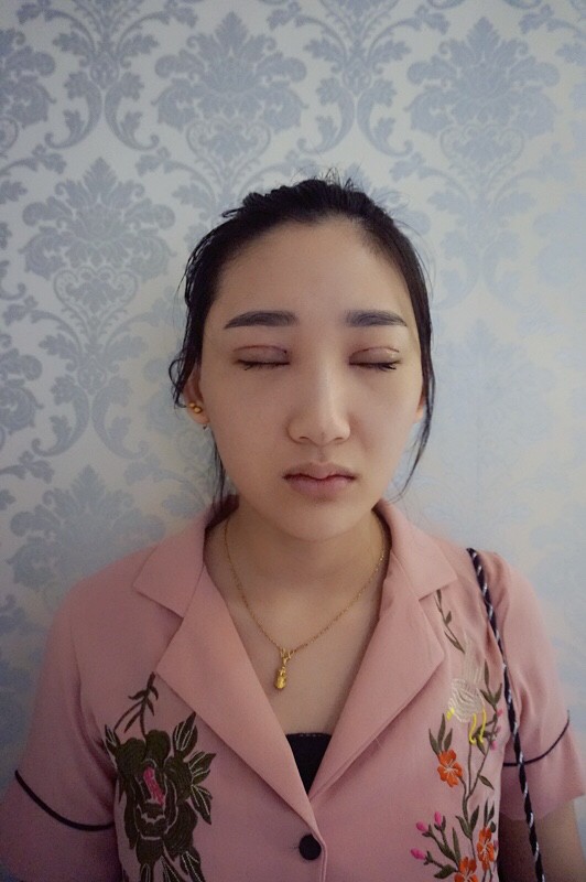 武漢中翰整形外科醫(yī)院沈磊醫(yī)生做切開(kāi)雙眼皮怎么樣？附沈磊切開(kāi)雙眼皮案例