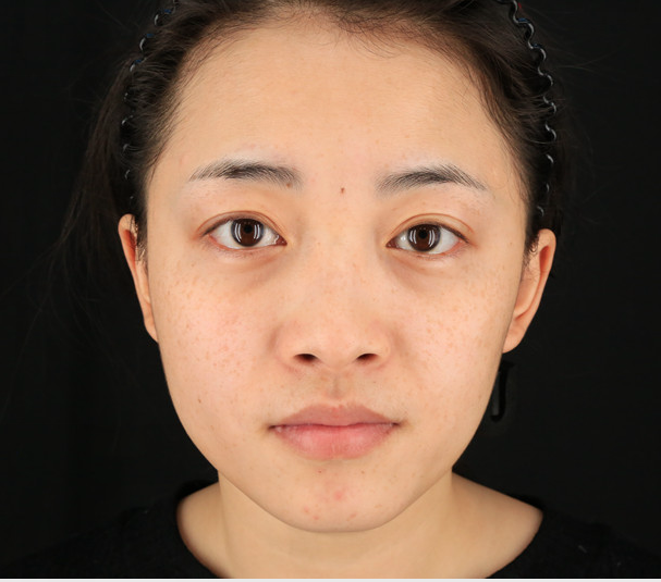 重慶當(dāng)代整形李敏旭醫(yī)生做皮秒激光祛斑效果怎么樣？附皮秒激光祛斑案例