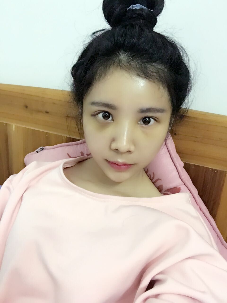 西安高一生醫(yī)療美容醫(yī)院網(wǎng)購恒醫(yī)生做自體脂肪全臉填充案例效果對比圖