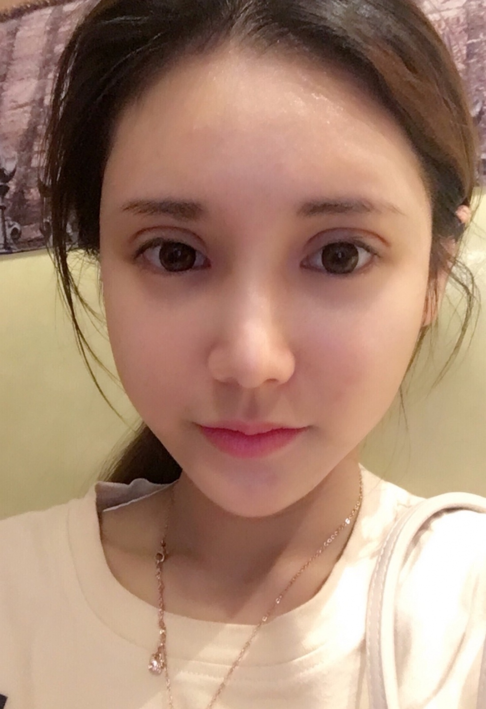 鄭州銘藝整形醫(yī)生陳濤做切開雙眼皮怎么樣？鄭州銘藝切開雙眼皮案例