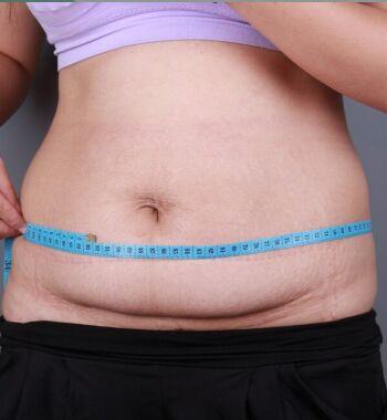 武漢東方麗人醫(yī)院整形美容科胡江偉醫(yī)生做腰腹吸脂案例效果對(duì)比圖